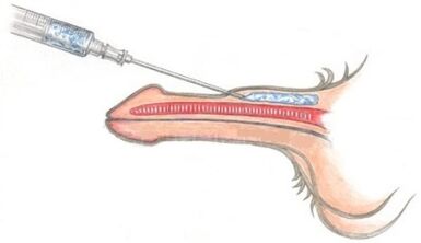 marirea penisului injectabil